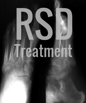 Ketamine IV Therapy Can Help With Reflex Sympathetic Dystrophy (RSD)