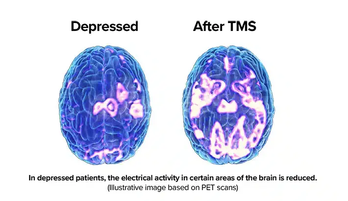 side by side brain scans with dpressed on the left and after TMS treatment on the right. In depressed patients, the electircal activity in certain areas of the brain is reduced. Images based on PET scans. side by side brain scans with dpressed on the left and after TMS treatment on the right. In depressed patients, the electircal activity in certain areas of the brain is reduced. Images based on PET scans.